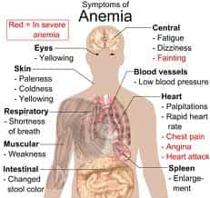 Anemia