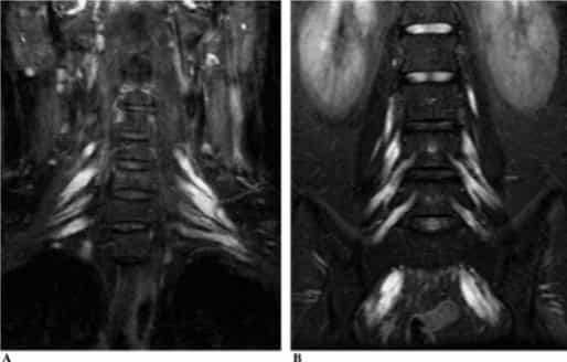 spinal root