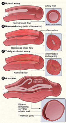  Illustration of a normal artery, narrowed artery, totally occluded artery, and aneurysm
