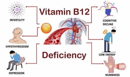B-12 deficiency