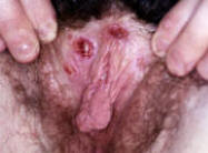 Vulval ulcer