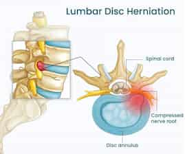 LUMBAR DISC