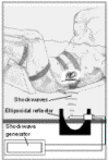 Illustration of extracorporeal shockwave lithotripsy