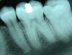 X-ray of a tooth