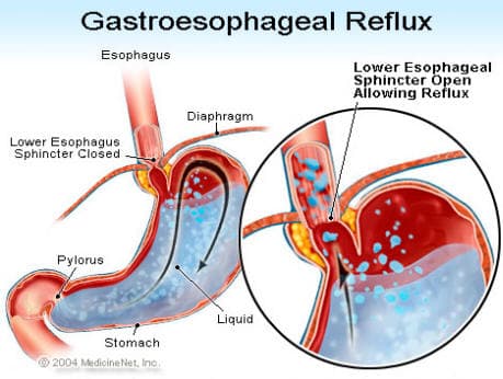 Gastro esophageal reflux