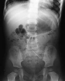 X-ray of one-year old showing a pin.