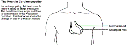 In cardiomyopathy, the heart muscle loses its ability to pump effectively. The heart becomes larger as it tries to compensate for its weakened condition. The illustration is of a normal heart with an enlarged heart superimposed.