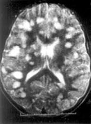 ADEM MRI scan