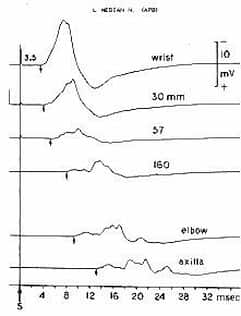 conduction block