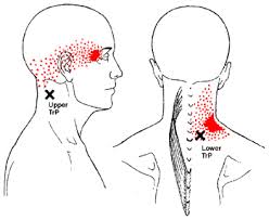 Painful neck muscle