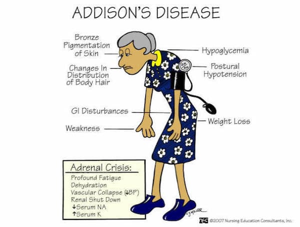 Addison disease