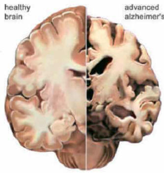 Alzheimer brain