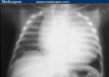 Figure 2: Severe cardiomegaly in classic infantile Pompe disease.