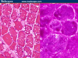 Figure 5: Left, hematoxylin and eosin stain showing vacuolated muscle fibers.