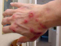 Morgellons - New Disease, or Man-Made Weapon of Terror?