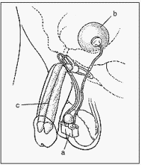 Drawing of an inflatable implant to treat erectile dysfunction. An erection is produced by squeezing a small pump (a) implanted in a scrotum. The pump causes fluid to flow from a reservoir (b) residing in the lower pelvis to two cylinders (c) residing in the penis. The cylinders expand to create the erection.