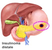 Insulinoma