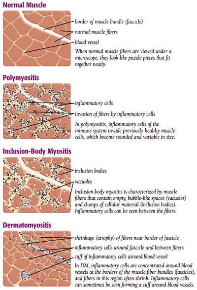 How can you treat myositis?