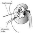 Illustration of percutaneous nephrolithotomy