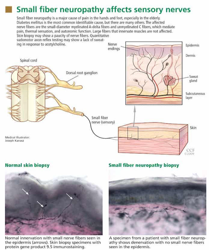 Small fiber neuropathy