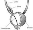 Illustration of ureteroscopic stone removal
